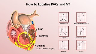 Advanced EKGs  Ventricular Tachycardia Classification amp Localization [upl. by Anasxor]