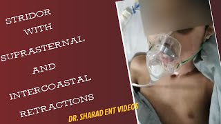 STRIDOR SOUND with SUPRASTERNAL amp INTERCOASTAL RETRACTIONS shorts shortsvideo viral shortvideo [upl. by Yetnom]