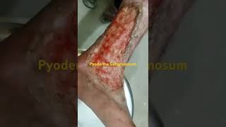 The Truth About Pyoderma Gangrenousum [upl. by Bow]