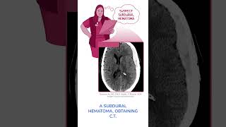 Diagnostics on Demand Subdural hematoma [upl. by Duarte]