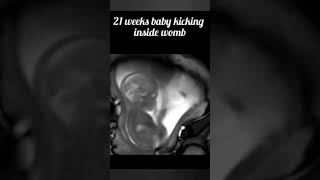 baby kick in womb।।baby kicking in the womb ultrasound 21 weeks pregnant।।shortsviarlshortbaby [upl. by Noreh]