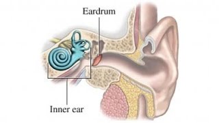 Meniere Disease [upl. by Carrel]