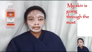 Using Calamine lotion  Caticura and Aqueous cream for clear skin [upl. by Krista]