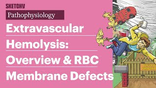 Extravascular Hemolysis amp RBC Defects Pathophysiology Part 1  Sketchy Medical  USMLE Step 1 [upl. by Neehcas]