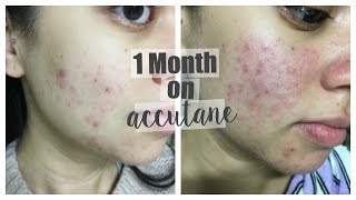 MY SKIN STORY  1 Month Update [upl. by Bilek483]