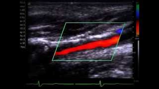 Doppler de carótidas e vertebrais [upl. by Lewert]