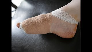 Bunion Surgery Pt 3  New Doctor  Orthopedic Surgeon [upl. by Yerg79]