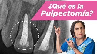 Pulpectomía ¿Qué es ¿Cuándo se debe hacer [upl. by Alexandrina]