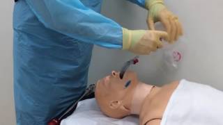 Intubation via the AirQ supraglottic airway [upl. by Woo]