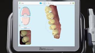 iTero® Scanner Tutorial Charting and Scanning for an Implant [upl. by Maribel]