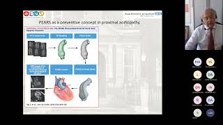 CLICC Day 4 Screening surveillance and management of patients with aortopathy [upl. by Rebna]