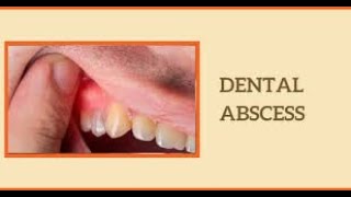 Understanding Dental Abscess Causes Symptoms and Treatment shorts youtubeshorts [upl. by Parfitt]