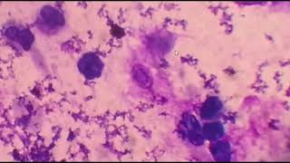 Pneumocystis pneumonia causative agent lab diagnosis and treatment [upl. by Gunther669]