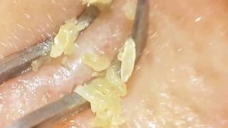 Huge yellow clogged pores removal with clip curved tweezers Blackheads Removal [upl. by Lehcnom]