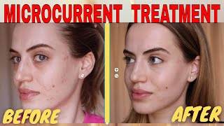 MICROCURRENT FACIAL BEFORE AND AFTER  NUOVALUCE MICROCURRENT REVIEW 2021  Madella Beauty [upl. by Ennairod]