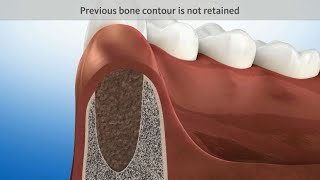 Extracted tooth without ridge preservation [upl. by Marva86]