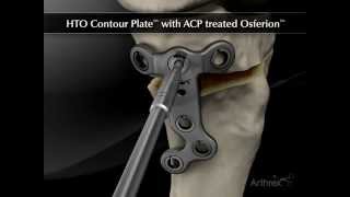 HTO ContourLock HTO Plate with ACP treated OSferion [upl. by Anitsej]