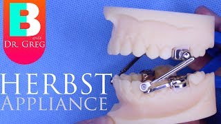 BRACES EXPLAINED Herbst Appliance [upl. by Derby267]