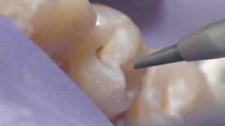 Dental Air Abrasion  Denville NJ [upl. by Leor]