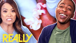 “I’m Ready To Get Popped Sliced And Extracted”  Dr Pimple Popper This Is Zit [upl. by Sitto]