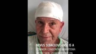 Nevus sebaceous basal cell carcinoma  Cyprus Facial Surgery [upl. by Ititrefen628]