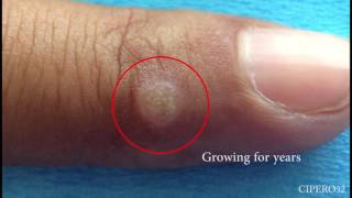 Wart Removal  Cryotherapy [upl. by Matland]