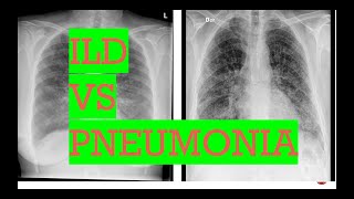 Chest Xray interstitial lung disease vs PneumoniaTypes of opacities in lungs [upl. by Dion205]