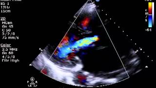 Aortic amp Mitral Regurgitation [upl. by Atilol]