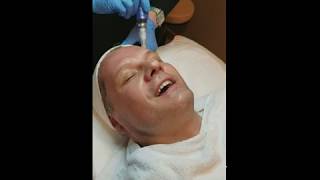 Micro Needling Treatment for Skin Wrinkles [upl. by Ortensia]