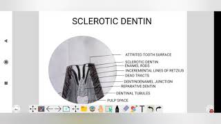 sclerotic dentin dental histologyDADH [upl. by Ezmeralda]