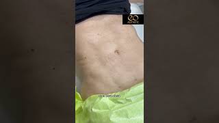 TRATAMIENTO FIBROSIS POST LIPOSUCCIÓN CON ENZIMAS EN EO CLÍNICA [upl. by Arag808]