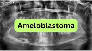 What is Ameloblastoma With mnemonic [upl. by Etsirhc739]