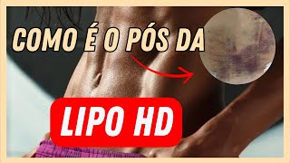 COMO É O PÓS OPERATORIO DE LIPO HD cirurgia [upl. by Earal768]