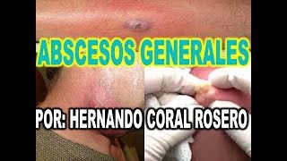 ABSCESOS GENERALES  INFECCIÓN E INFLAMACIÓN INTERNA O EN LA PIEL [upl. by Ellesirg135]