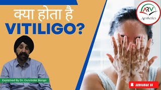 Understanding Vitiligo Treatment  Dr Gurvinder Banga Explains [upl. by Garbers247]