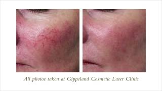 Gentle Max Pro Vascular Laser Treatment  Sparkle Lifestyle amp Medispa [upl. by Airliah]