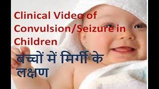 clinical video of convulsionseizure in children [upl. by Notsew804]