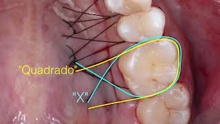 Sutura suspensória compressiva Sutura do X quadrado Full HD [upl. by Einial63]