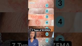 7 Eczema Types How to Tell Which One You Have [upl. by Attenol4]