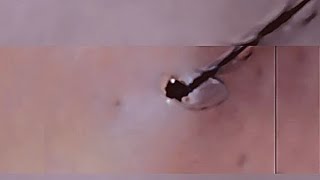 Removal of ingrown hair [upl. by Lavinia768]