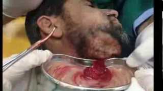 Hilton method for abscess Incision amp Drainage Subcutaneous تفجير خراج مسافة شدقية سني المنشأ [upl. by Shep]