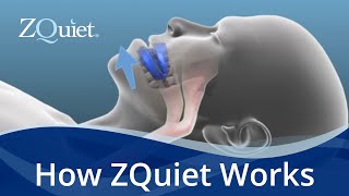 Want to Stop Snoring Learn How ZQuiet Anti Snoring Mouthpieces Work [upl. by Ydolem]