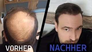 Haartransplantation Wie sieht das Ergebnis nach einem Jahr aus [upl. by Semela995]