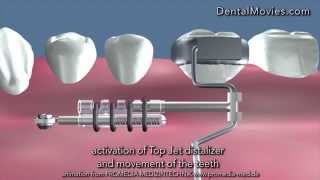 Distalization of the molar using Top Jet Distalizer [upl. by Neehsuan]