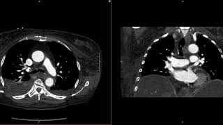 What To Do When You Notice A Filling Defect [upl. by Thorley905]