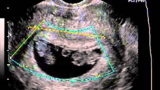 Ultrasonido de gemelos en las primeras semanas [upl. by Ylreveb125]