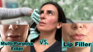 Lip Fillers 450 Compared to 700  RestylaneJuvederm Versus Restylane Kysse [upl. by Haywood]