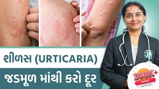 Ayurvedic Treatment Of Urticaria  Dr Devangi Jogal  JOGI Ayurved [upl. by Ijnek]