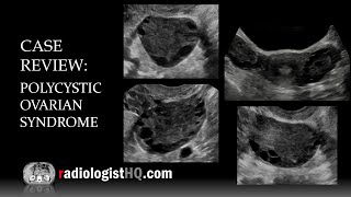 Ultrasound of Polycystic Ovarian Syndrome [upl. by Kumler]