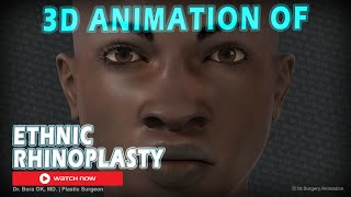 Dr Bora Ok MD  3D Animation Of Ethnic Rhinoplasty Surgery [upl. by Stine]